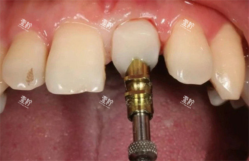 前牙美学修复实拍.jpg