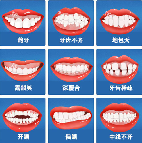 牙齿矫正适应症.jpg 牙齿矫正适应症.jpg