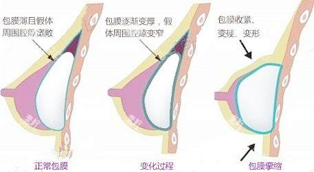 假体隆胸包膜挛缩.png 假体隆胸包膜挛缩.png