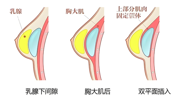 假体隆胸植入层次.png 假体隆胸植入层次.png