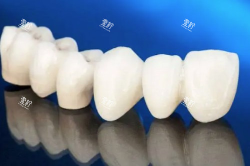 爱尔创全瓷牙模型图.jpg 爱尔创全瓷牙模型图.jpg