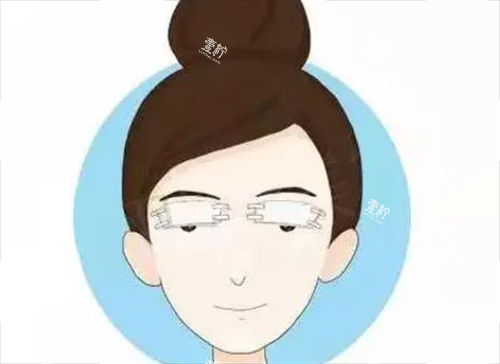 双眼皮术后.png 双眼皮术后.png