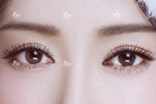 临沂兰山小娅倾城割双眼皮多少钱？5999元起，附丰院长眼综合攻略