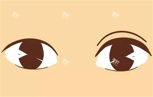 双眼皮手术的前后对比.jpg 双眼皮手术的前后对比.jpg