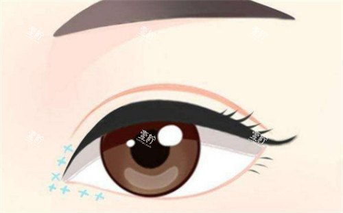 眼综合手术后眼部的样子.jpg 眼综合手术后眼部的样子.jpg