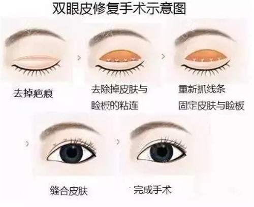 双眼皮修复示意图.jpg 双眼皮修复示意图.jpg