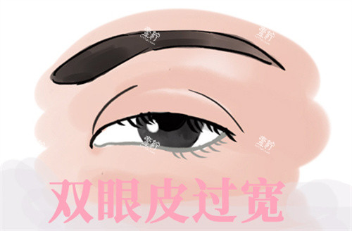 双眼皮过宽修复.jpg 双眼皮过宽修复.jpg