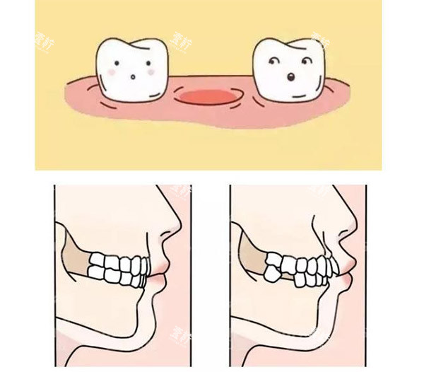 缺牙照片.jpg