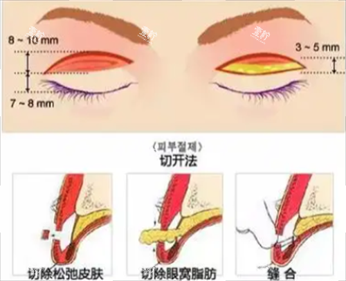 切开双眼皮手术.png 切开双眼皮手术.png