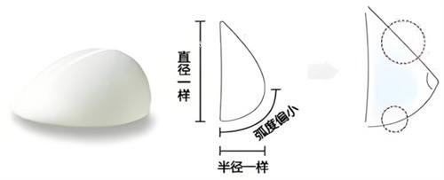 假体隆胸水滴形.jpg 假体隆胸水滴形.jpg