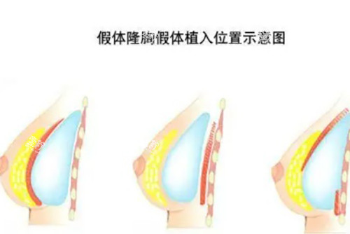 假体隆胸示意图.jpg 假体隆胸示意图.jpg