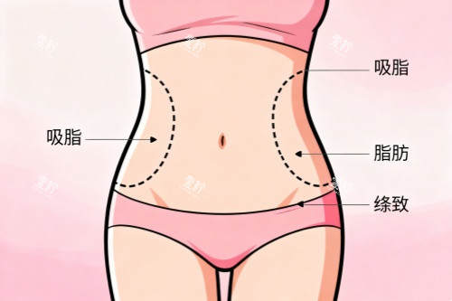 小蛮腰吸脂塑形卡通图.jpg 小蛮腰吸脂塑形卡通图.jpg