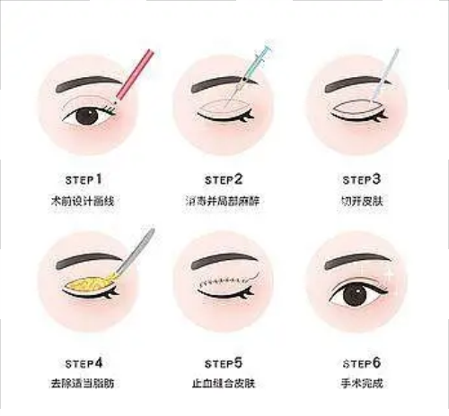 全切双眼皮流程图示.png