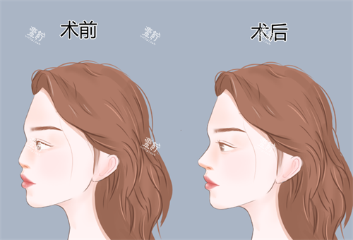 鼻整形手术对比.png
