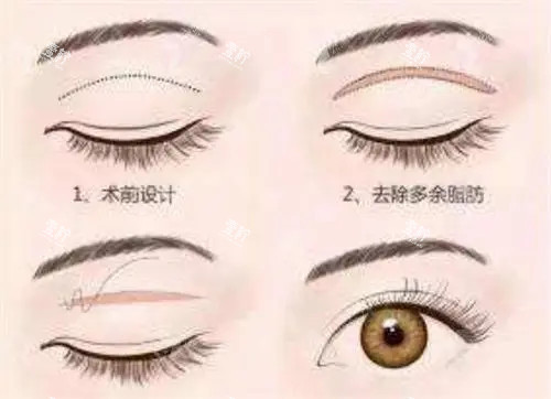 全切双眼皮卡通示意图.jpg