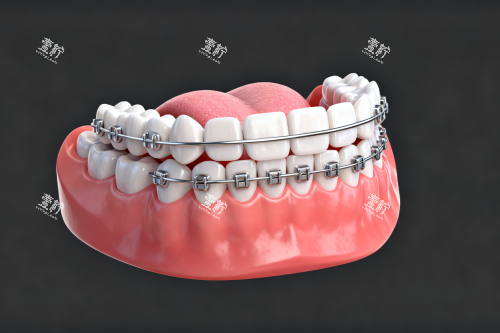 传统自锁矫正器展示图.png
