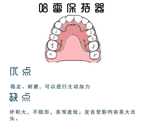 牙齿矫正哈雷保持器.jpg