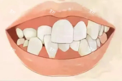 牙齿畸形卡通模型图.jpg