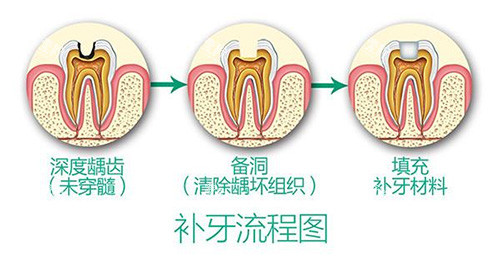 补牙流程.jpg
