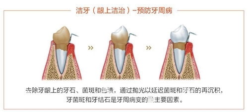 洗牙龈上洁治过程示意图.jpg