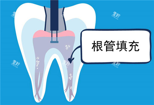 根管填充图示.jpg
