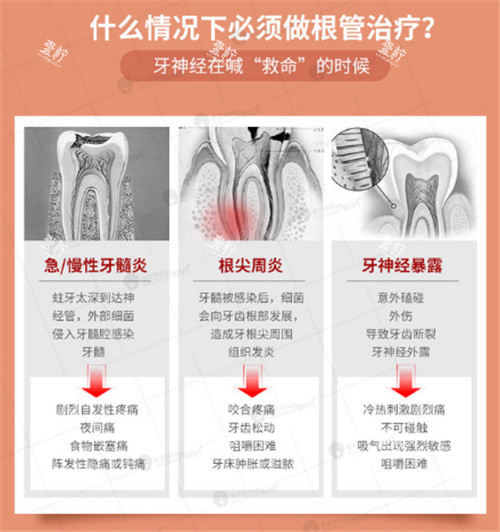 适合做根管治疗的情况.jpg