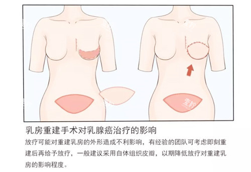 乳房重建手术图片一览.jpg