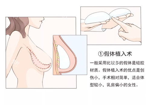 乳房重建手术图片.jpg