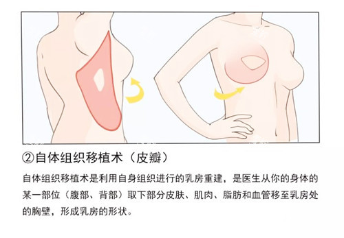 乳房重建手术卡通图.jpg