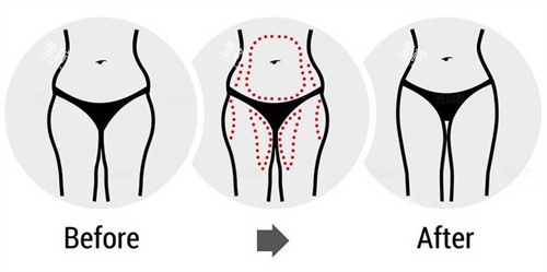 腰腹大腿吸脂前后对比图.jpg