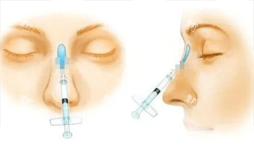 玻尿酸注射隆鼻动画展示图.png 玻尿酸注射隆鼻动画展示图.png
