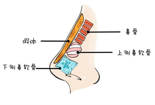 隆鼻假体图.jpg