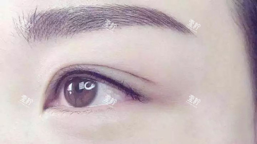 双眼皮实拍.jpg
