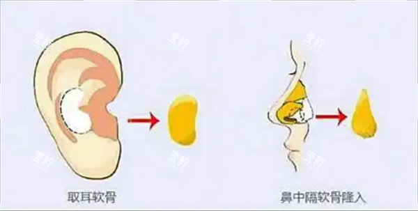 耳软骨隆鼻.png