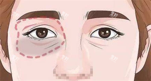 泪沟眼袋画线展示图.jpg