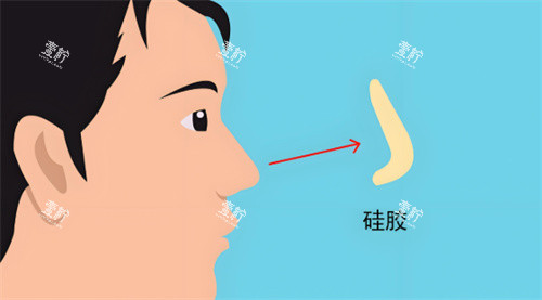 硅胶假体隆鼻.jpg 硅胶假体隆鼻.jpg