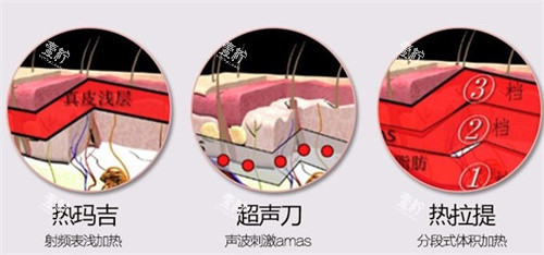 热玛吉、超声、热拉提.jpg 热玛吉、超声、热拉提.jpg