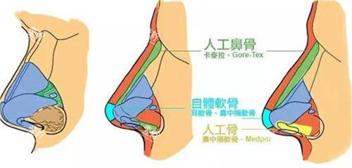 隆鼻手术对比.jpg 隆鼻手术对比.jpg