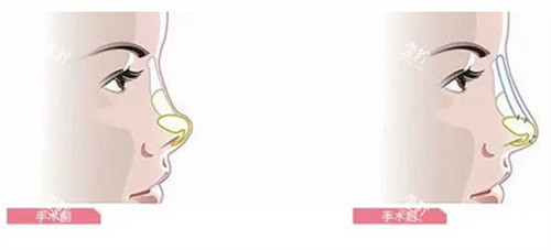 隆鼻手术前后对比.jpg 隆鼻手术前后对比.jpg