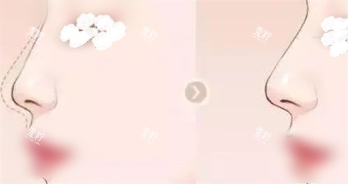 隆鼻鼻部鼻梁术前术后展示图.jpg 隆鼻鼻部鼻梁术前术后展示图.jpg