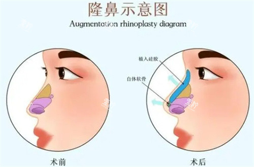 隆鼻前后对比.jpg 隆鼻前后对比.jpg