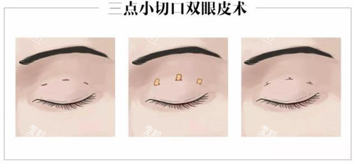 三点定位双眼皮的操作步骤.jpg