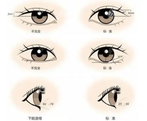 双眼皮对比图.JPG