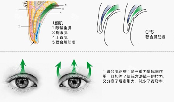 双眼皮失败修复cfs悬吊.jpg