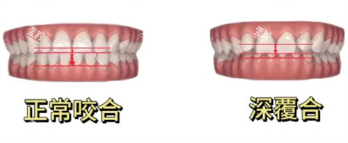 正常咬合和深覆合对比.jpg