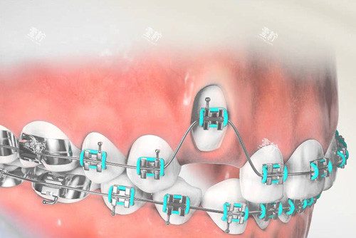 虎牙牙齿矫正过程.jpg
