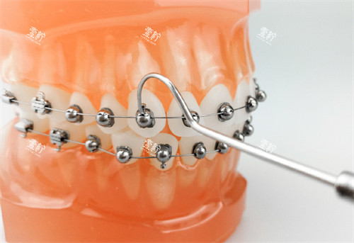 牙齿矫正OBrace球面托槽矫正牙套模型.jpg 牙齿矫正OBrace球面托槽矫正牙套模型.jpg