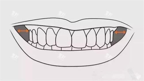 牙齿矫正扩牙弓颊廊.jpg 牙齿矫正扩牙弓颊廊.jpg