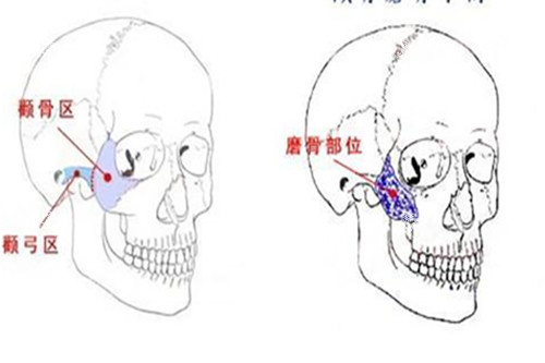 颧骨磨骨手术示意图.jpg