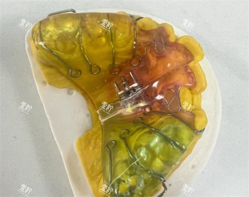粘接式扩弓器外观.jpg